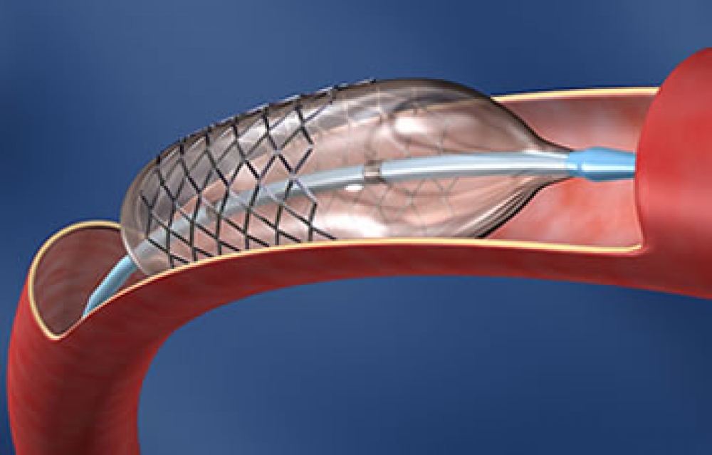 Stent para Coração