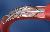 Stent para Coração